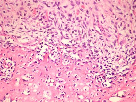 Osteosarcoma Histology Labeled