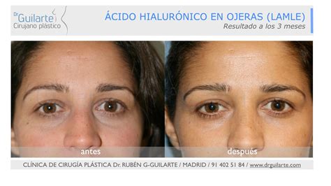 Fotos Antes y Después Relleno Ojeras. Opiniones Ácido Hialurónico