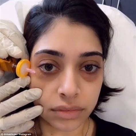 Carboxy therapy injects carbon dioxide under women's eyes for dark circles | Daily Mail Online