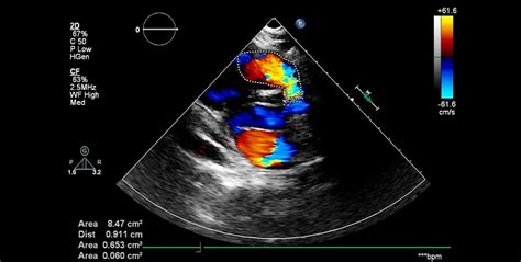 Colour Doppler Ultrasound | Visualizing Blood Flow Precision