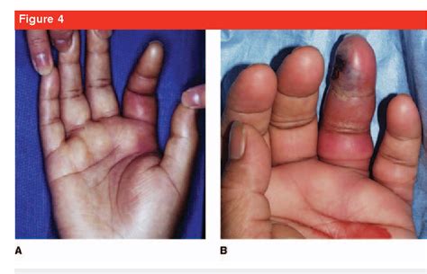 Flexor tendon sheath infections of the hand. | Semantic Scholar