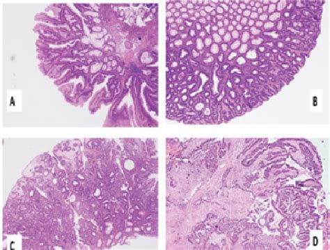 Spectrum of adenoma -adenocarcinoma sequence. A) Villous adenoma, B)... | Download Scientific ...