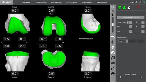 Mako Robotic Arm Assisted Total Knee | Stryker Orthopaedics UK