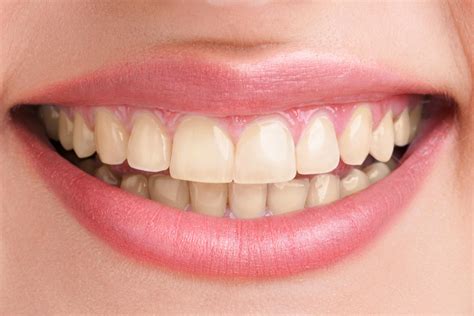 Teeth Whitening at Oakville Dental Care | Cosmetic Services