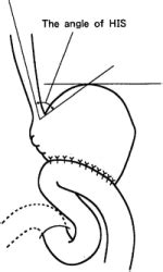 Angle of His - Anatomy, Function, Disorders and Pictures