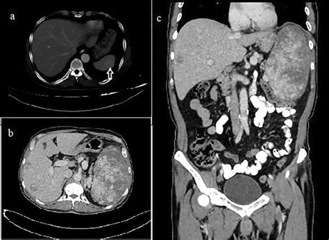 a) CT scan showing 2.5 cm in size splenic hemangioma. (b; transverse,... | Download Scientific ...