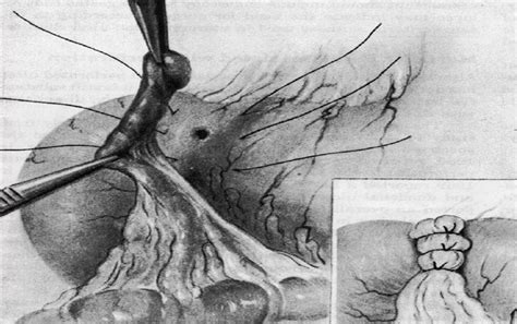 The schema of Graham's Live omental patch closure. | Download Scientific Diagram