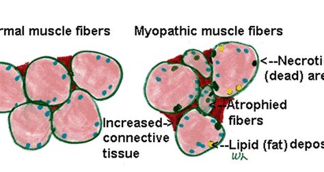 What is steroid myopathy?