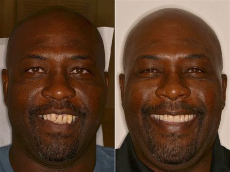 All-on-4 ® Dental Implants Photos | Miami | Patient 9671