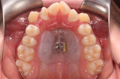 Palatal Expanders: Why, How, and When