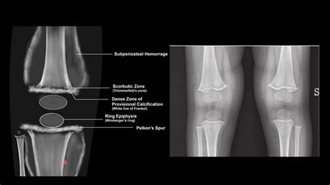 SCURVY VS RICKETS- RADIOLOGY - YouTube