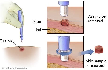 Skin Punch Biopsy | Rederm Medical Center