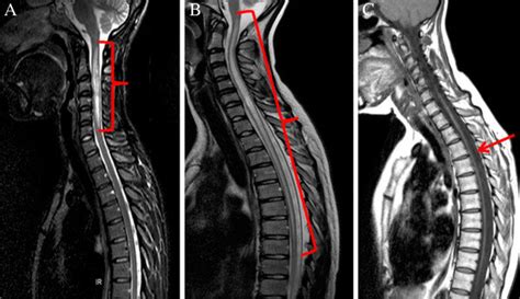 Longitudinally extensive transverse myelitis (LETM) and atrophy of... | Download Scientific Diagram