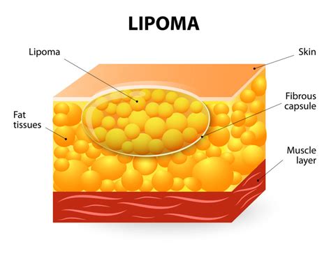 Lipomas – Causes & Treatment Methods | Woodbury General Surgeon