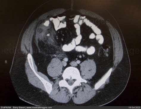 STOCK IMAGE, ct scan axial section showing a right lower quadrant abscess with a fecalith from a ...