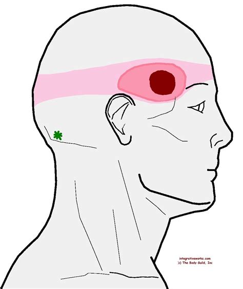 Pin on Headache - Trigger Point Pain