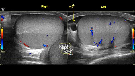 Epididymal Cyst Ultrasound