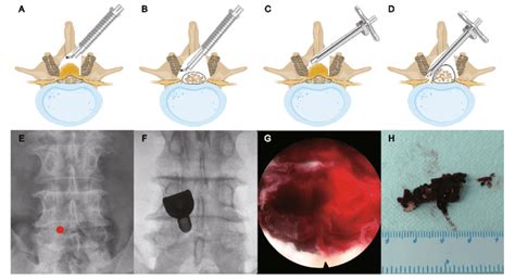 Schematic of unilateral laminotomy for bilateral decompression (a-d ...