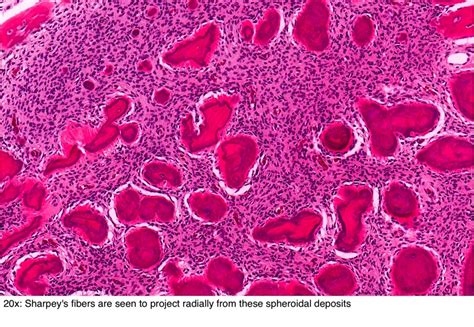 Pathology Outlines - Cemento-ossifying fibroma / ossifying fibroma