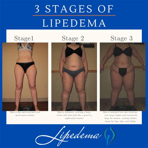 lipedema fat Archives - Lipedema