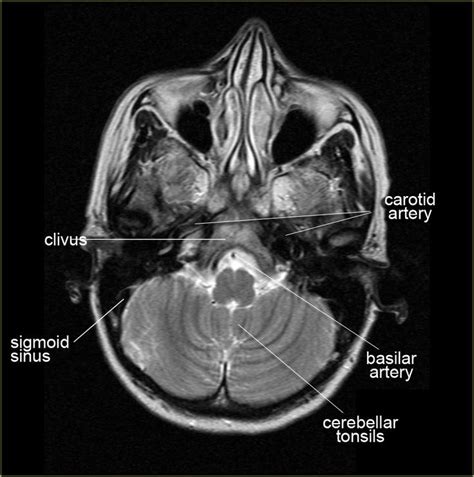 On the left a coronal view of the segments of the middle cerebral ...