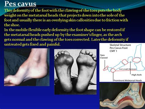 Pes planovalgus - kumrecovery