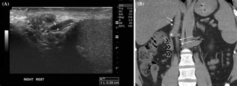 43-year-old male with isolated right-sided varicocele and anomalous... | Download Scientific Diagram