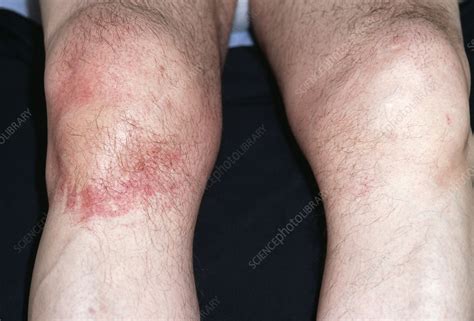 Rash from deep heat cream - Stock Image - M320/0332 - Science Photo Library