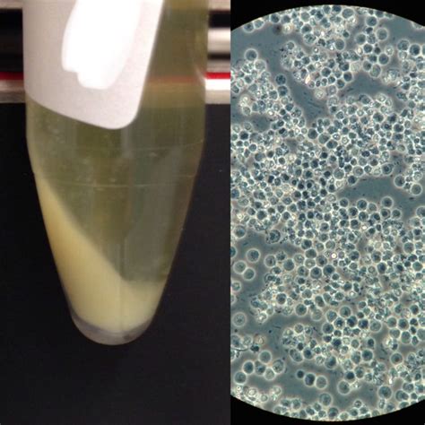 Urine Sediment of the Month: The Visible Sediment - Renal Fellow Network