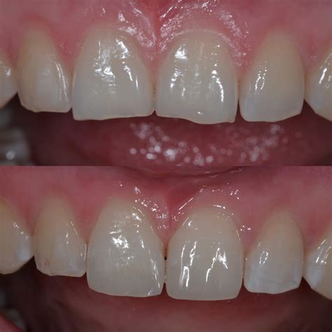 Gallery - Composite Resins Bonding - Uptown Guelph Dental