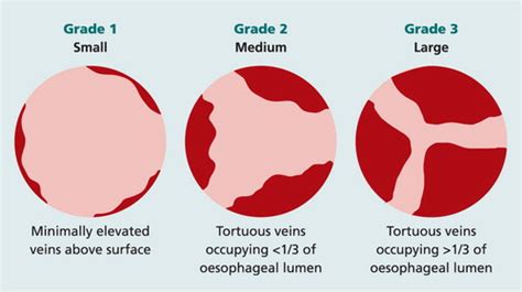 Esophageal Varices Grading