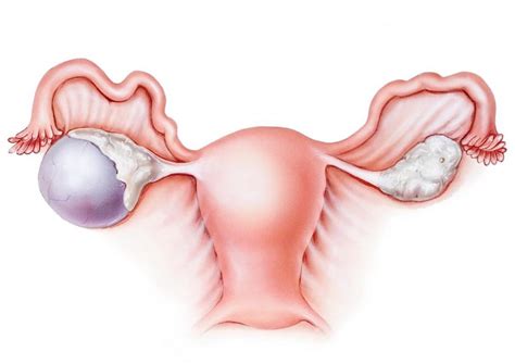 Important Things to Know About Ovarian Cyst - Get Health Care Tips