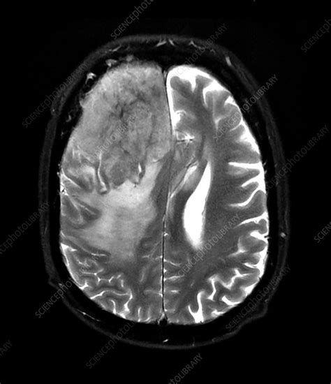 MRI of Invasive Meningioma - Stock Image - C043/0281 - Science Photo Library