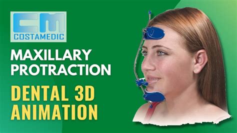 Maxillary Protraction Animation | reverse pull headgear before and ...