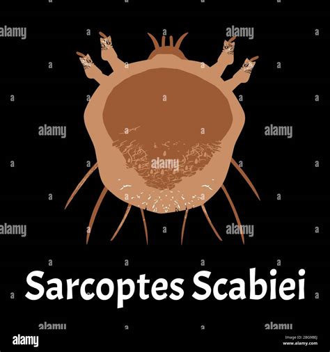 Sarcoptes scabiei. scabies. Sexually transmitted disease. Infographics. illustration on isolated ...