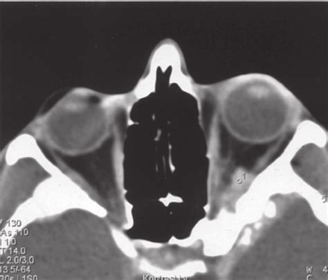 Orbit computed tomography: left optic nerve meningioma with... | Download Scientific Diagram