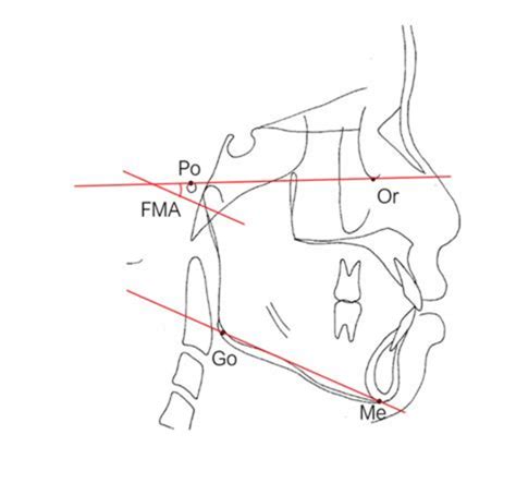 The Frankfort-mandibular plane angle (FMA). The FMA is formed by the... | Download Scientific ...