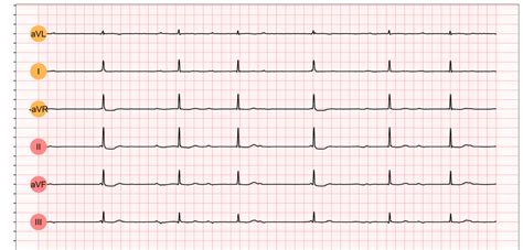 Third-degree AV block (3rd degree AV block, AV block 3, AV block III) – Cardiovascular Education