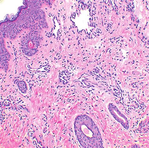 Capillary malformation in a 3-month-old patient with a port-wine stain ...