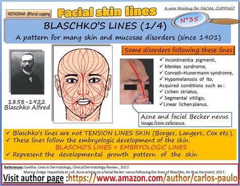 Facial skin lines n°35 -BLASCHKO'S LINES | Facial skin, Skin line ...