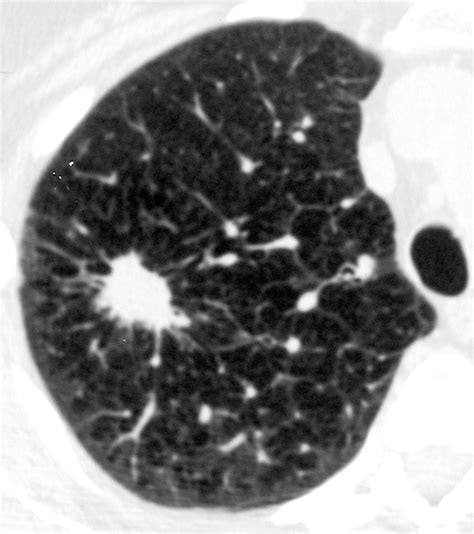 Necrotizing Granuloma of the Lung: Imaging Characteristics and Imaging ...