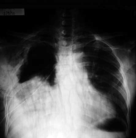 Chest X-ray taken on the day of admission revealed flail segment at... | Download Scientific Diagram