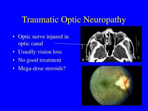 PPT - Ocular Trauma PowerPoint Presentation - ID:2399670