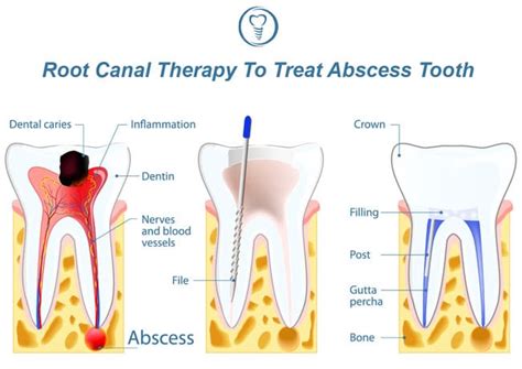 Abscess Tooth