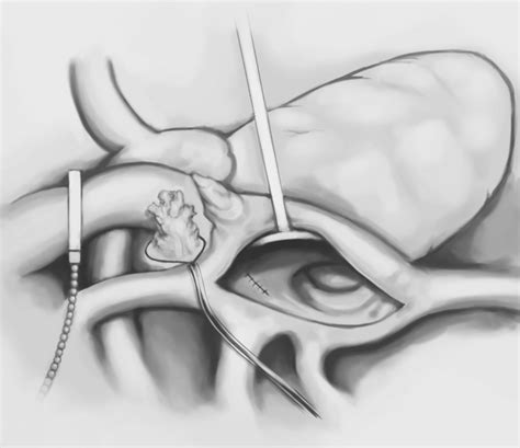 Left atrial appendage (LAA) ligation via a minimally invasive right ...