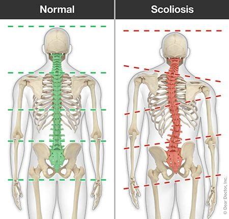 Scoliosis Chiropractor In St Augustine, FL | Derek Sisak, DC