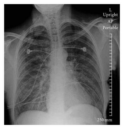 Case 2 chest X-ray at time 1744. Abnormal chest X-ray taken on ...