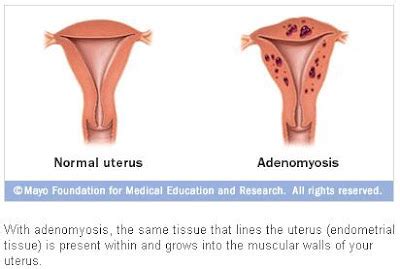 my beautiful U(terus): signs and symptoms of adenomyosis