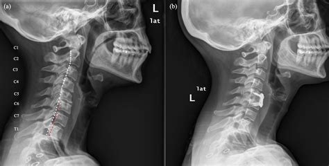 Does Cervical Spondylolisthesis Influence Patient-Reported Outcomes After Anterior Cervical ...