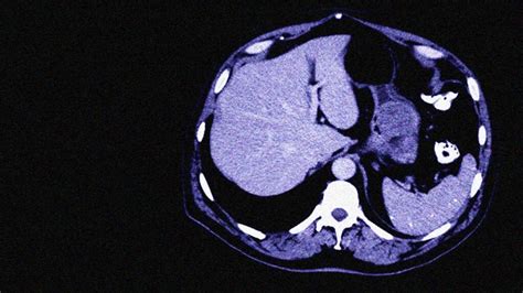 Gastrointestinal stromal tumor (GIST): Symptoms, treatment, outlook